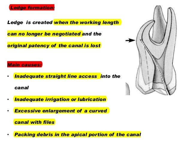 management of curved root canals pdf