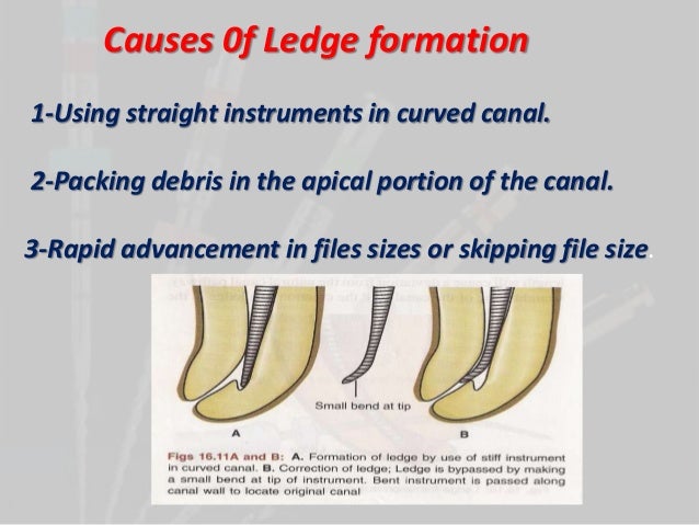 management of curved root canals pdf